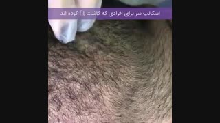 اسکالپ سر برای کاشت مو به روش FIT