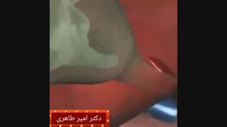 عمل جراحی برداشتن کیسه صفرا به روش لاپاراسکوپی