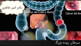 سرطان روده بزرگ | دکتر امیر طاهری