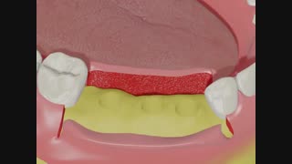 ایمپلنت | کلینیک دندانپزشکی تاج