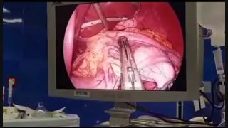 جراحی لاغری ( اسلیومعده ) تیم vip