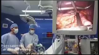 ویدیوی کامل از جراحی لاغری (اسلیومعده ) تیم VIP