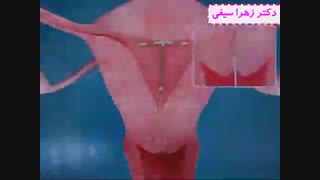نحوه کار گذاشتن IUD | دکتر زهرا سیفی