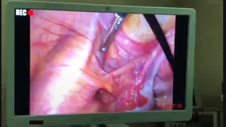 لاپاراسکوپی کیست درمویید