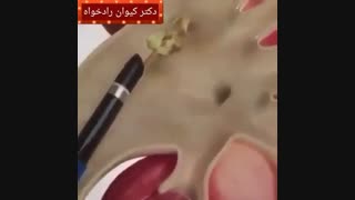 سنگ کلیه
