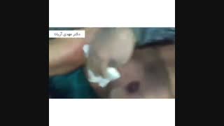نمونه ای از جراحی ژنیکوماستی توسط دکتر مهدی آریانا