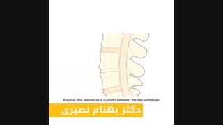 فتق دیسک کمر