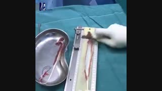 بازسازی رباط صلیبی