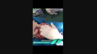 اصلاح خوردگی شدید استخوان با استفاده از استخوان خود بیمار | دکتر مسعود صابری جراحی پف زیر چشم