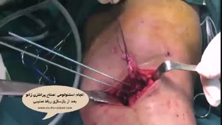 انجام استئوتومی اصلاح پرانتزی زانو بعد از بازسازی رباط صلیبی