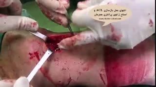 پایان عمل بازسازی ACL و اصلاح زانوی پرانتزی همزمان | دکتر مسعود صابری متخصص ارتوپد کلینیک مو