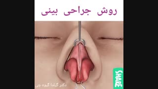 نحوه جراحی بینی