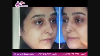 عمل بینی گوشتی