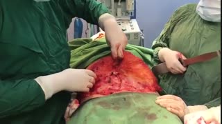 فیلم جراحی زیبایی شکم بعد از زایمان