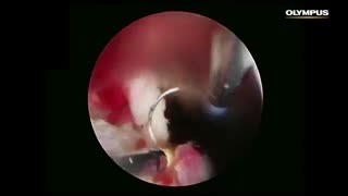 PLASMA Enucleation of the Prostate