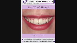 درمان ارتودنسی ثابت | دکتر فیروزی