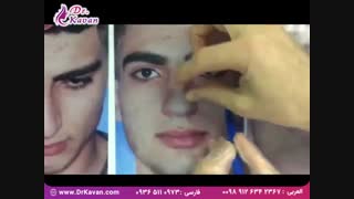 برداشتن قوز بینی توسط دکتر کاوان