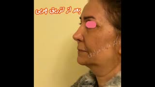 جوانسازی صورت با تزریق چربی | دکتر ماریا مرادی جراح پلاستیک و صورت کربوکسی تراپی