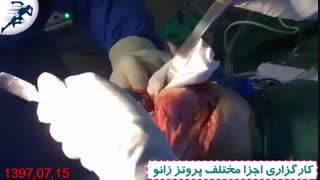 کارگزارى اجزا مختلف پروتز زانو