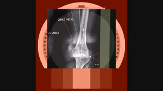 نتیجه عمل تعویض مفصل زانو