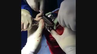 نحوه اتصال پروتز زانو