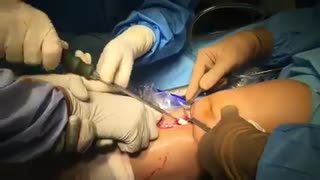 جراحی بازسازی acl