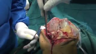 جراحی و درمان تخریب شدید زانو