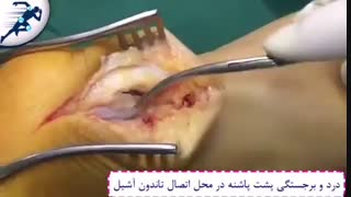 درد و برجستگی پشت پاشنه