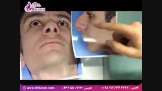 جراحی بینی گوشتی