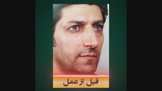 جراحی بینی مردان