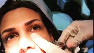 تزریق ژل زیر چشم