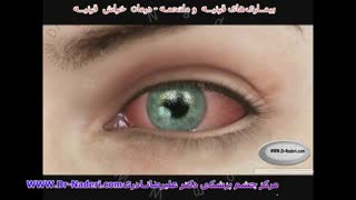 درمان خراش قرنیه - مرکز چشم پزشکی دکتر علیرضا نادری