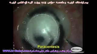 پیوند لایه ای قدامی قرنیه - مرکز چشم پزشکی دکتر علیرضا نادری