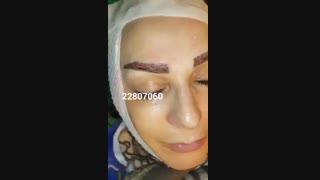 کاشت ابرو - دکتر ابدالی - 22807060
