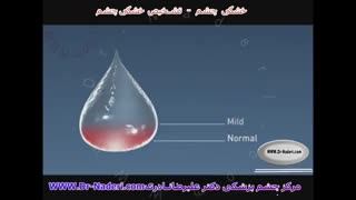 تشخیص خشکی چشم - مرکز چشم پزشکی دکتر رضا نادری