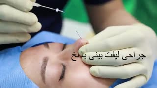 جراحی لیفت بینی با نخ - عمل بالا کشیدن نوک بینی - زیبایی سنتر