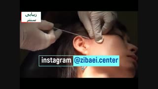 لیفت صورت با نخ - لیفتینگ صورت یا جوان سازی صورت - زیبایی سنتر