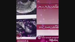 سونوگرافی جنین