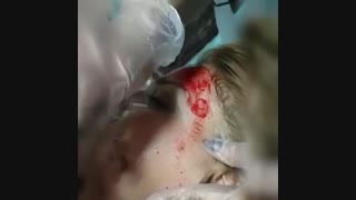 دستگاه و عملکرد میکرونیدلینگ صورت | دکتر مصطفی خدایاری