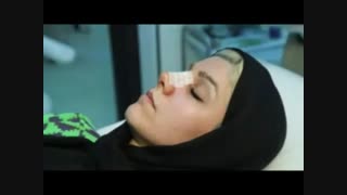 نحوه و آموزش چسب زدن بینی بعد از عمل جراحی بینی - زیبایی سنتر
