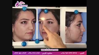 عمل بینی گوشتی