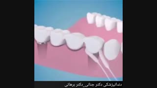 نحوه تمیز کردن بریج دندان