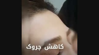 انجام پلکسر برای رفع پف چشم در کلینیک زیبایی تسنیم