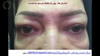 جراحی زیبایی پلک یا بلفاروپلاستی در مرکز چشم پزشکی دکتر علیرضا نادری