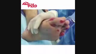 پیشگیری از تاول دیابتی