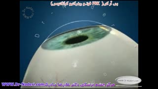 لیزر پی آر کی PRK - مرکز چشم پزشکی دکتر علیرضا نادری