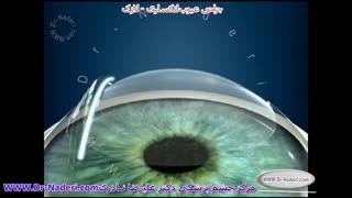 عمل جراحی لازک - مرکز چشم پزشکی دکتر علیرضا نادری