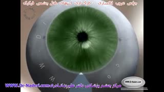 کارگذاری لنز آرتیزان و آرتیفلکس-مرکز چشم پزشکی دکتر علیرضا نادری