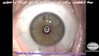 کار گذاری رینگ داخل قرنیه ای با فمتو لیزر- مرکز چشم پزشکی دکتر علیرضا نادری
