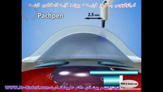 پیوند لایه ای قرنیه در قوز قرنیه - مرکز چشم پزشکی دکتر علیرضا نادری